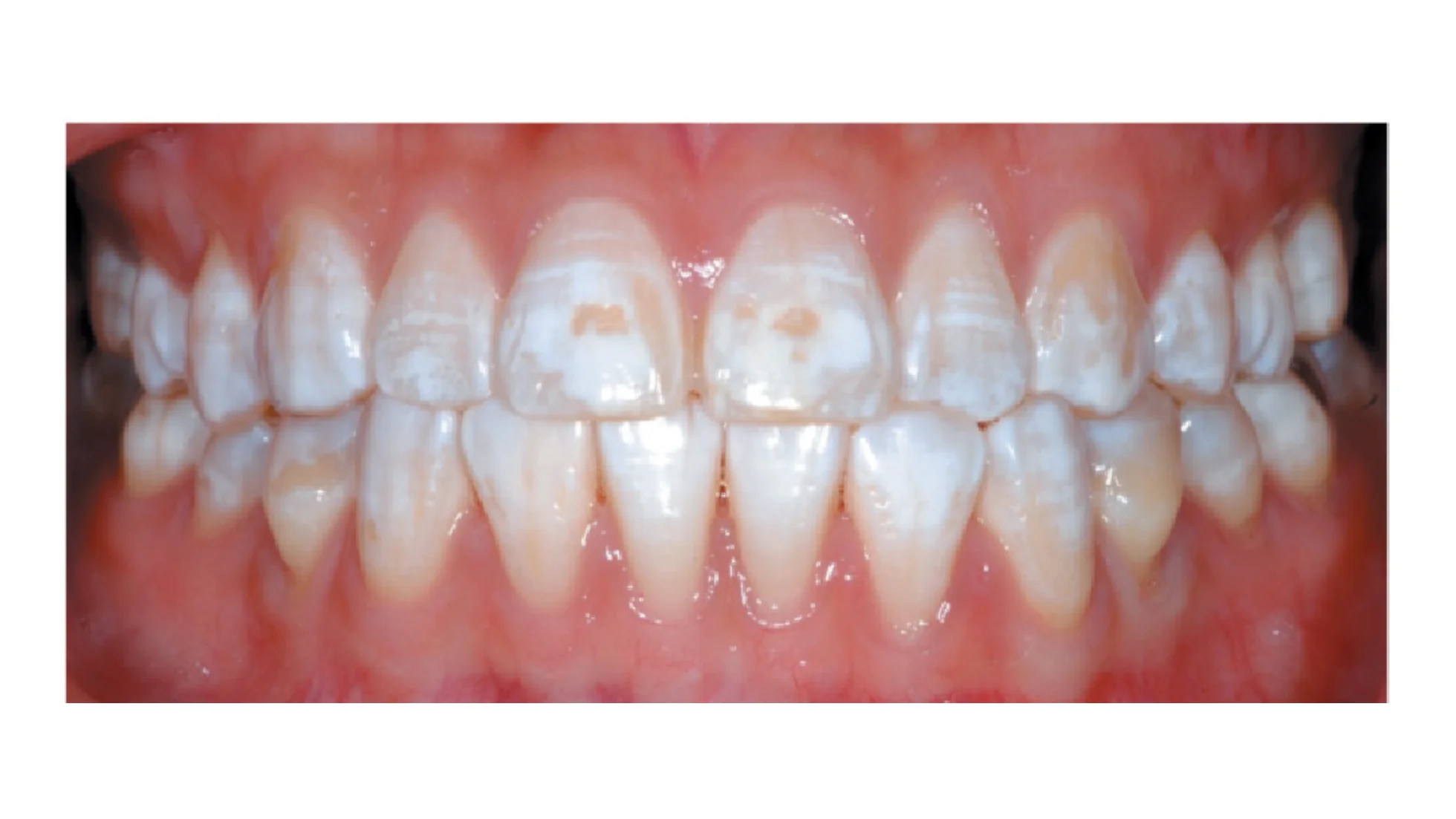 Fluorose Dentária