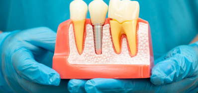 Preparo-para-pinos-intrarradiculares