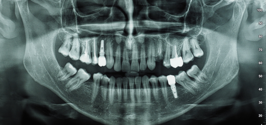 Reabsorções-radiculares-Significado_-importância-clínica-e-caminhos-do-controle-das-reabsorções-dent