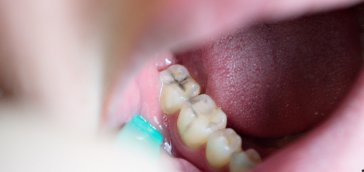 lesões cervicais não cariosas