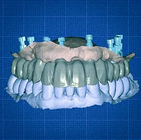 Protse sobre Implante Analogico e Digital 285 x 160px 2