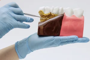 Doencas bucais ainda afetam bilhoes e avancam silenciosamente